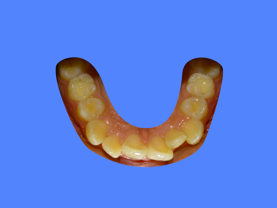 After image with patient showing aligned teeth
